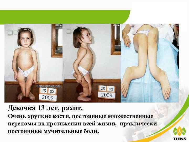 Девочка 13 лет, рахит. Очень хрупкие кости, постоянные множественные переломы на протяжении всей жизни,