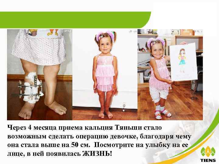 Через 4 месяца приема кальция Тяньши стало возможным сделать операцию девочке, благодаря чему она