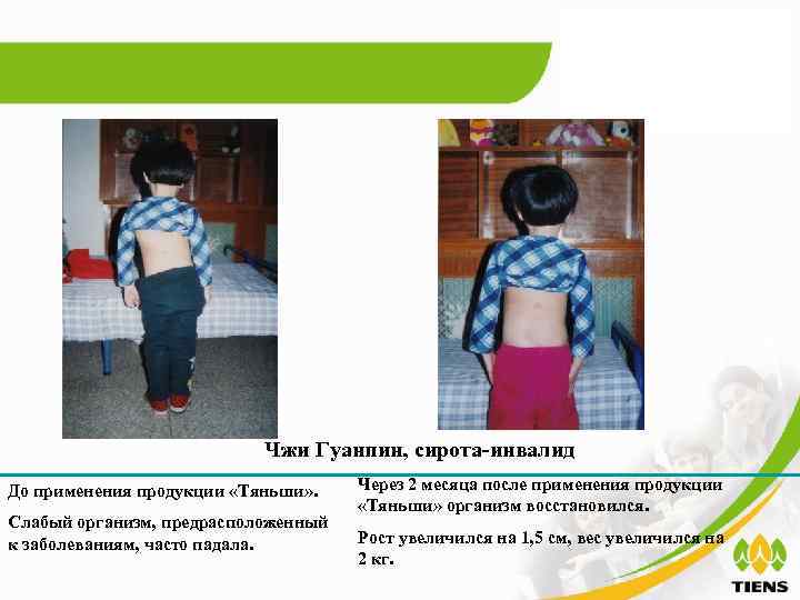       Чжи Гуанпин, сирота-инвалид До применения продукции «Тяньши» .