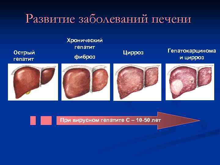   Развитие заболеваний печени   Хронический    гепатит Острый 