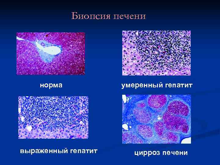   Биопсия печени   норма  умеренный гепатит выраженный гепатит цирроз печени