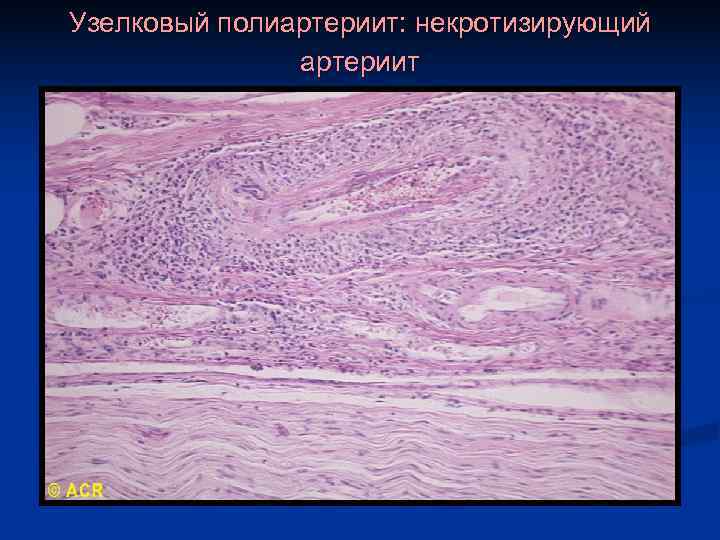 Узелковый полиартериит: некротизирующий    артериит 