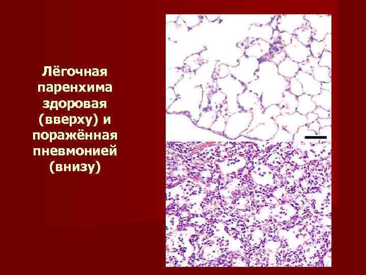  Лёгочная  паренхима  здоровая  (вверху) и поражённая пневмонией (внизу) 