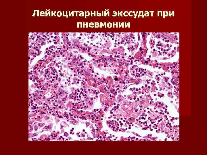 Лейкоцитарный экссудат при   пневмонии 