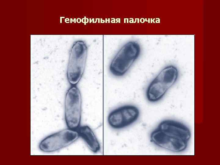 Гемофильная палочка. Гемофильная палочка пневмония. Haemophilus influenzae пневмония. Палочка Пфейффера. Гемофильная палочка возбудитель пневмонии.