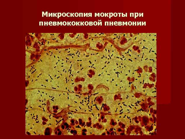  Микроскопия мокроты при пневмококковой пневмонии 