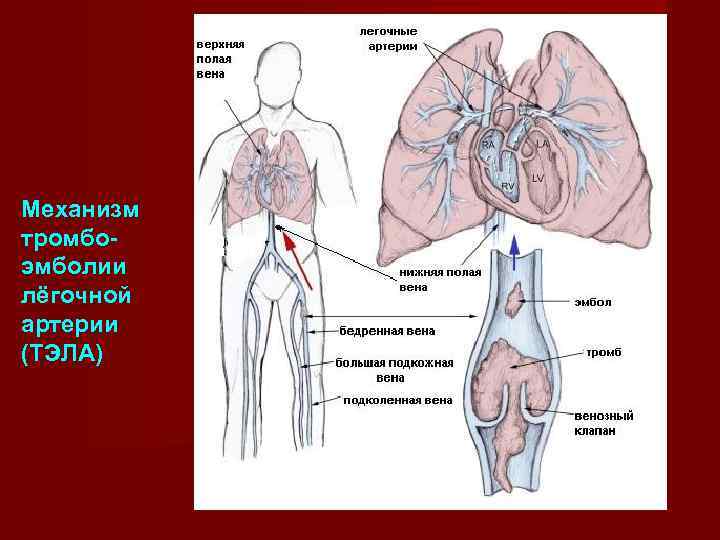 Механизм тромбо- эмболии лёгочной артерии (ТЭЛА) 