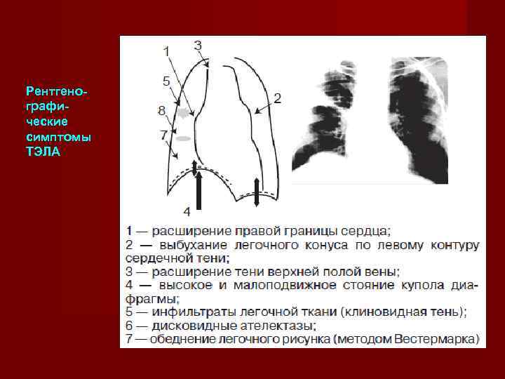 Рентгено- графи- ческие симптомы ТЭЛА 