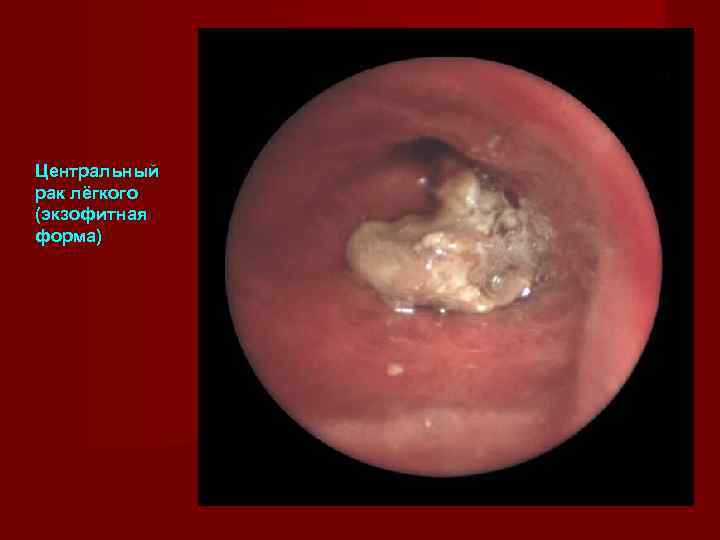 Центральный рак лёгкого (экзофитная форма) 