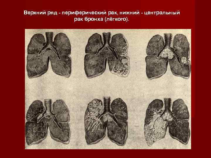 Верхний ряд - периферический рак, нижний - центральный    рак бронха (лёгкого).