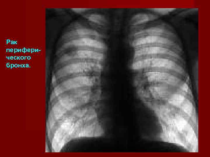 Рак перифери- ческого бронха. 