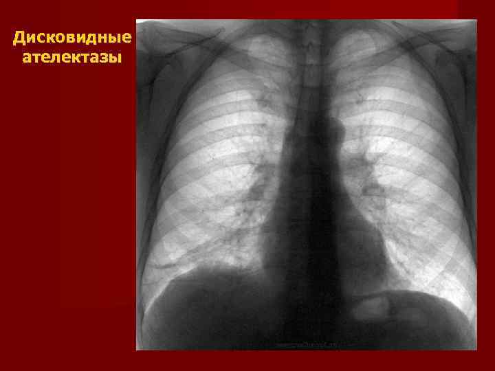 Дисковидные  ателектазы 