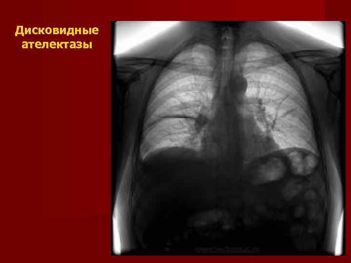 Дисковидные  ателектазы 