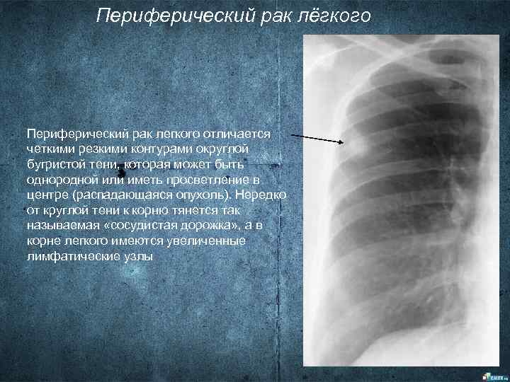 Как выглядит периферический рак легкого на компьютерной томографии