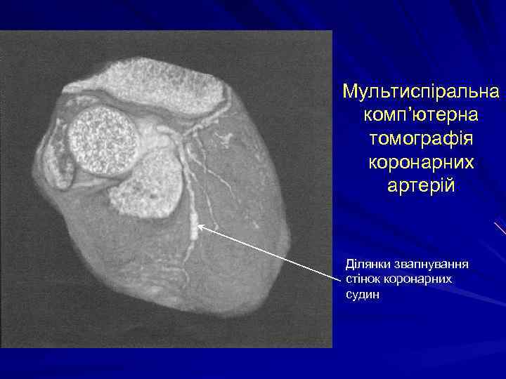 Мультиспіральна  комп’ютерна  томографія  коронарних артерій  Ділянки звапнування стінок коронарних судин
