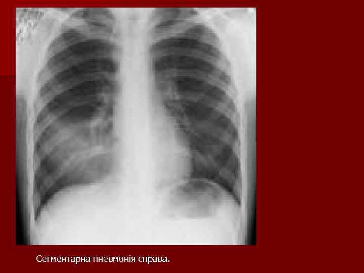 Сегментарна пневмонія справа. Сегментарна пневмонія справа.