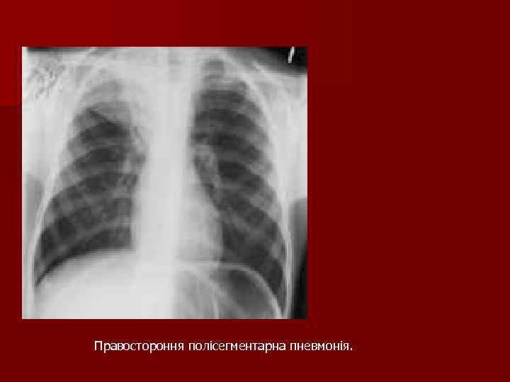 Правостороння полісегментарна пневмонія. Правостороння полісегментарна пневмонія.