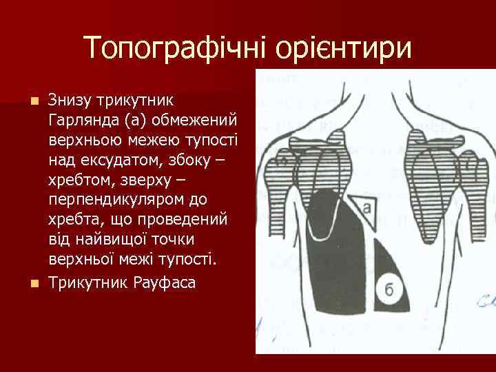 Топографічні орієнтири n Знизу трикутник Гарлянда (а) обмежений верхньою межею тупості Топографічні орієнтири n Знизу трикутник Гарлянда (а) обмежений верхньою межею тупості