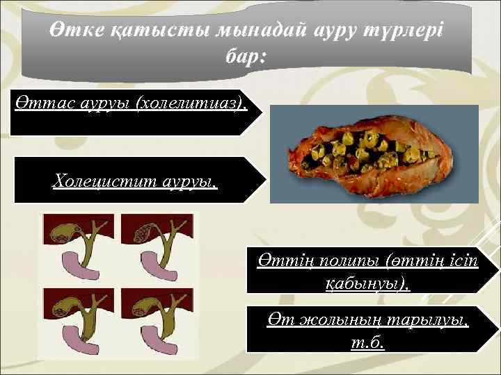   Өтке қатысты мынадай ауру түрлері   бар:  Өттас ауруы (холелитиаз),
