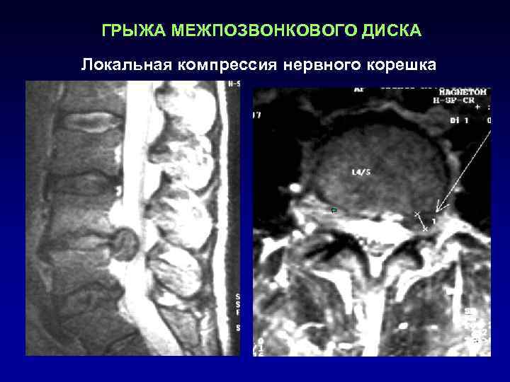  ГРЫЖА МЕЖПОЗВОНКОВОГО ДИСКА Локальная компрессия нервного корешка 