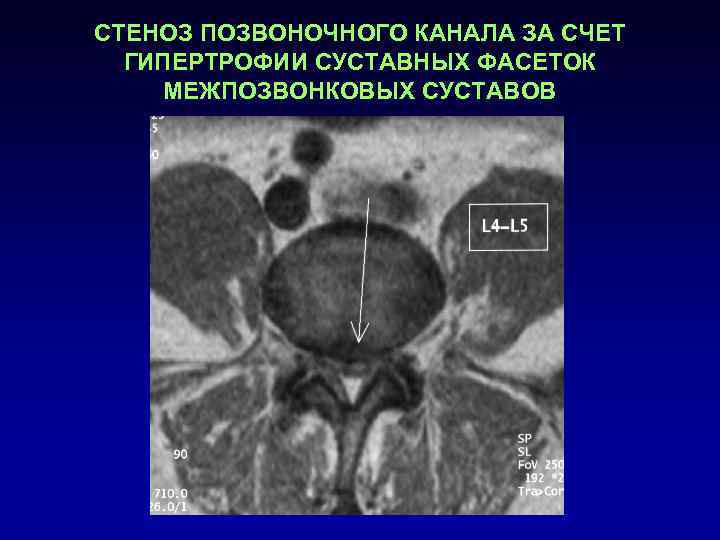 СТЕНОЗ ПОЗВОНОЧНОГО КАНАЛА ЗА СЧЕТ  ГИПЕРТРОФИИ СУСТАВНЫХ ФАСЕТОК МЕЖПОЗВОНКОВЫХ СУСТАВОВ 