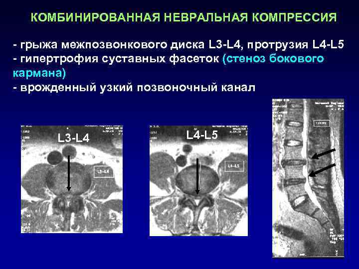  КОМБИНИРОВАННАЯ НЕВРАЛЬНАЯ КОМПРЕССИЯ - грыжа межпозвонкового диска L 3 -L 4, протрузия L