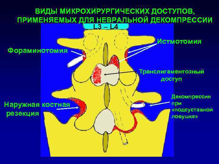  ВИДЫ МИКРОХИРУРГИЧЕСКИХ ДОСТУПОВ, ПРИМЕНЯЕМЫХ ДЛЯ НЕВРАЛЬНОЙ ДЕКОМПРЕССИИ    L 3 –