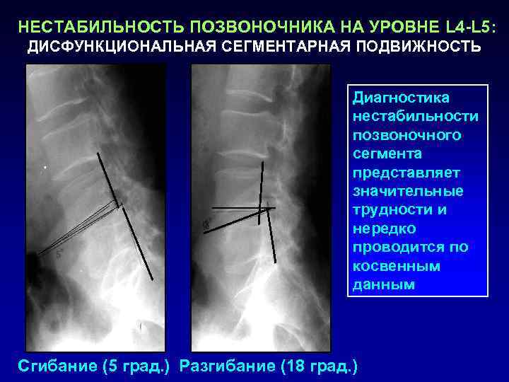 НЕСТАБИЛЬНОСТЬ ПОЗВОНОЧНИКА НА УРОВНЕ L 4 -L 5:  ДИСФУНКЦИОНАЛЬНАЯ СЕГМЕНТАРНАЯ ПОДВИЖНОСТЬ  