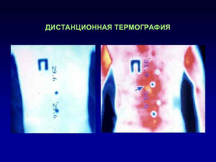 ДИСТАНЦИОННАЯ ТЕРМОГРАФИЯ 