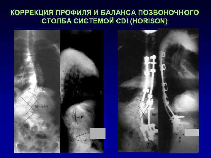 КОРРЕКЦИЯ ПРОФИЛЯ И БАЛАНСА ПОЗВОНОЧНОГО  СТОЛБА СИСТЕМОЙ CDI (HORISON) 