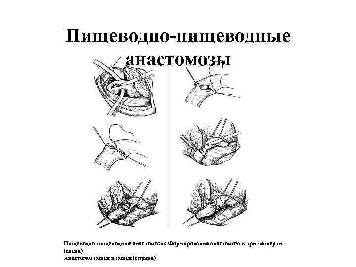 Пищеводно-пищеводные анастомозы: Формирование анастомоза в три четверти (слева) Анастомоз конец в конец (справа) 