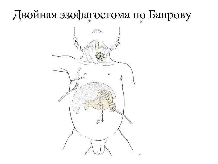 Двойная эзофагостома по Баирову 