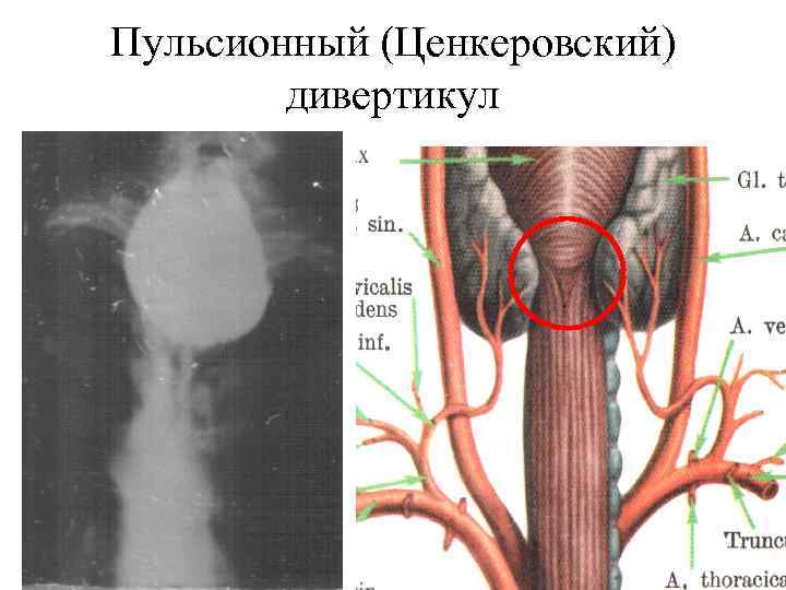 Пульсионный (Ценкеровский)   дивертикул 