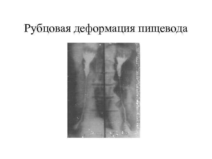 Рубцовая деформация пищевода 