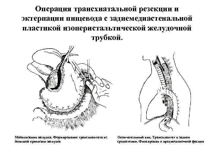  Операция трансхиатальной резекции и  эктерпации пищевода с заднемедиастенальной  пластикой изоперистальтической желудочной