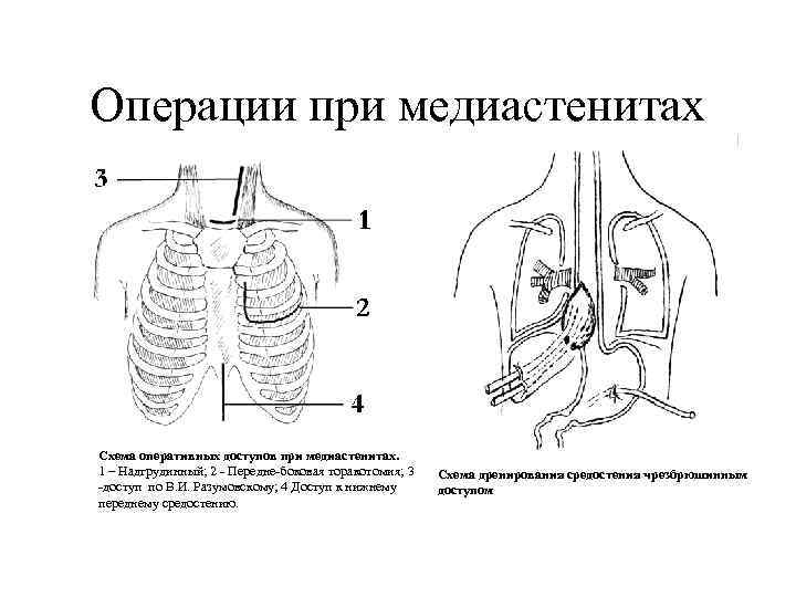 Операции при медиастенитах Схема оперативных доступов при медиастенитах. 1 – Надгрудинный; 2 - Передне-боковая