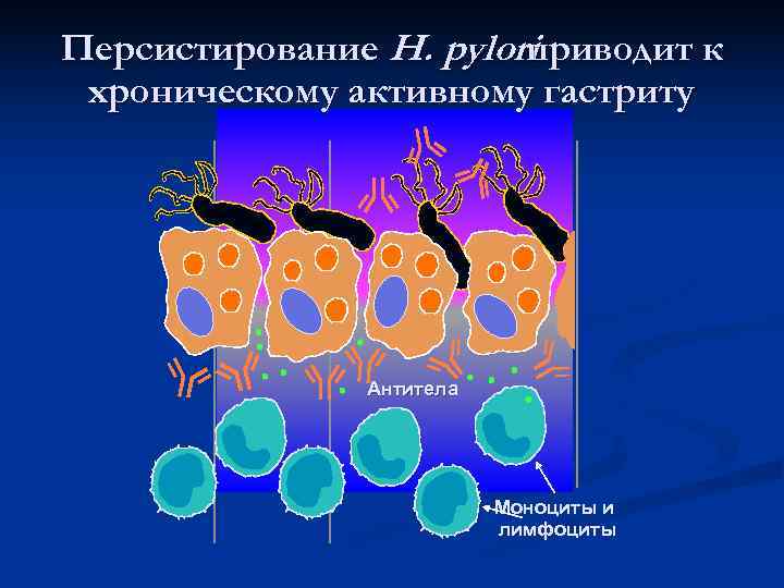 Персистирование H. pylori приводит к хроническому активному гастриту Персистирование H. pylori приводит к хроническому активному гастриту