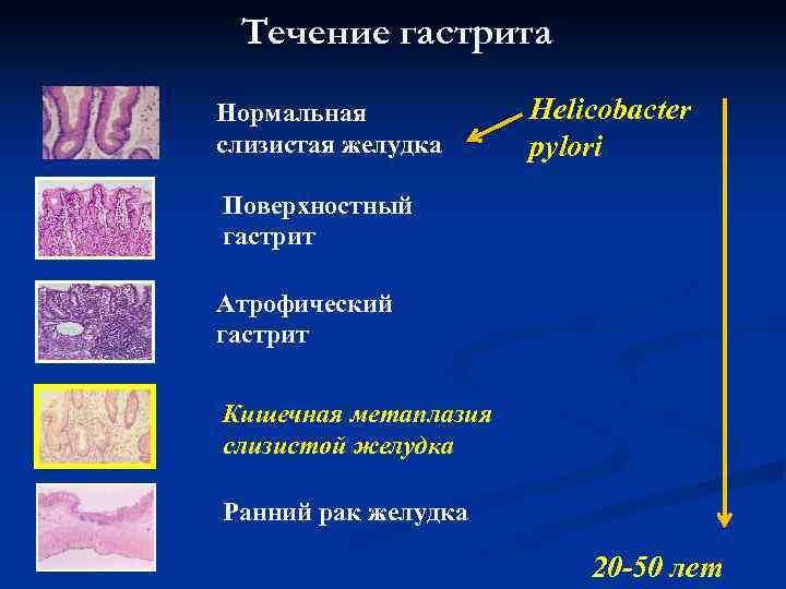 Течение гастрита Нормальная Helicobacter слизистая желудка pylori Поверхностный гастрит Атрофический гастрит Течение гастрита Нормальная Helicobacter слизистая желудка pylori Поверхностный гастрит Атрофический гастрит
