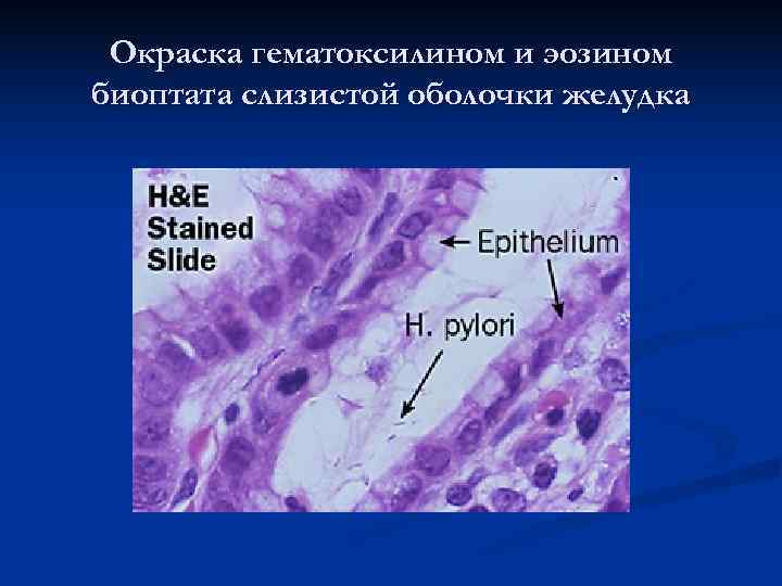 Биоптат слизистой желудка. Окраска гематоксилином и эозином. Хеликобактер гематоксилин эозин. Биоптат слизистой оболочки желудка что это такое. Хеликобактер пилори в биоптате.