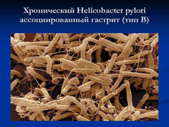 Хронический Helicobacter pylori ассоциированный гастрит (тип В) Хронический Helicobacter pylori ассоциированный гастрит (тип В)