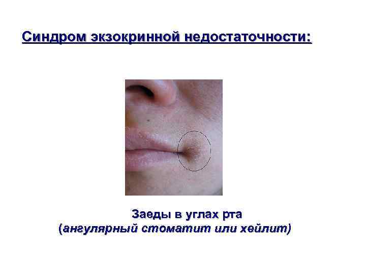 Синдром экзокринной недостаточности:    Заеды в углах рта (ангулярный стоматит или хейлит)