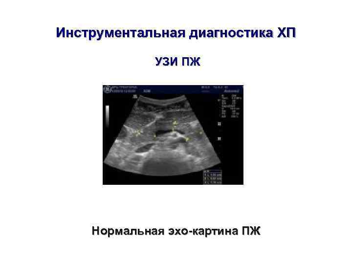 Инструментальная диагностика ХП    УЗИ ПЖ   Нормальная эхо-картина ПЖ 