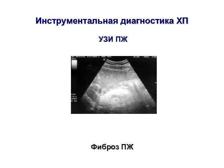 Инструментальная диагностика ХП    УЗИ ПЖ    Фиброз ПЖ 