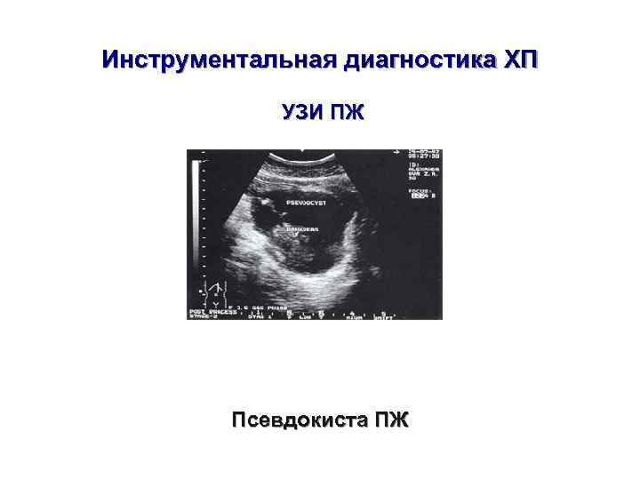 Инструментальная диагностика ХП    УЗИ ПЖ   Псевдокиста ПЖ 