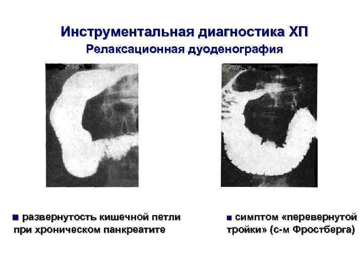    Инструментальная диагностика ХП    Релаксационная дуоденография ■ развернутость кишечной