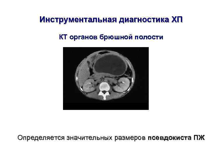  Инструментальная диагностика ХП  КТ органов брюшной полости Определяется значительных размеров псевдокиста ПЖ
