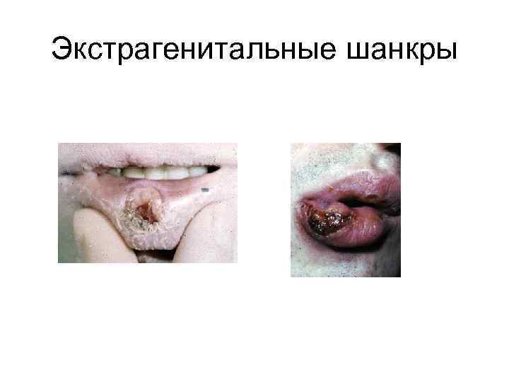 Экстрагенитальные шанкры 