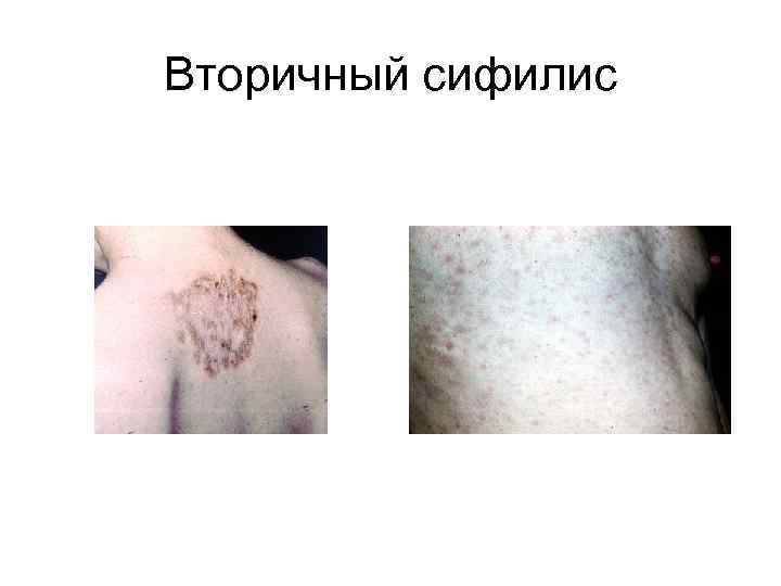 Вторичный сифилис 