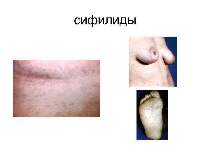 сифилиды 