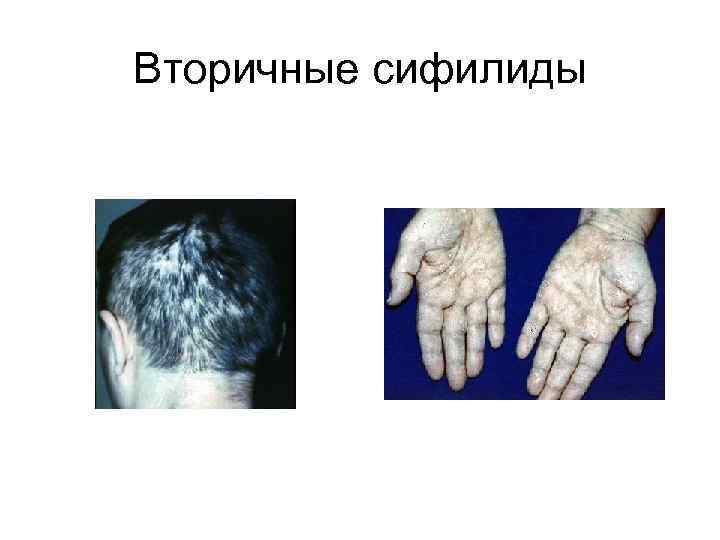 Вторичные сифилиды 